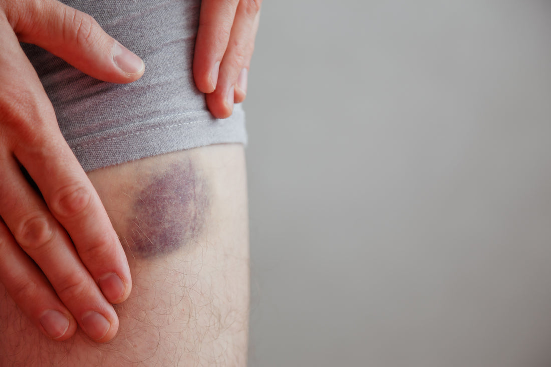 Bruises | Swelling & Inflammation